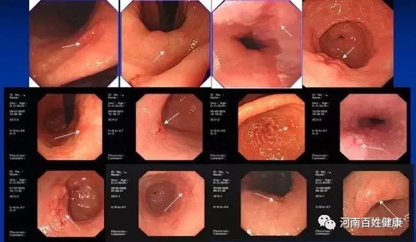 最新胃肠镜技术，医学领域的革新之星