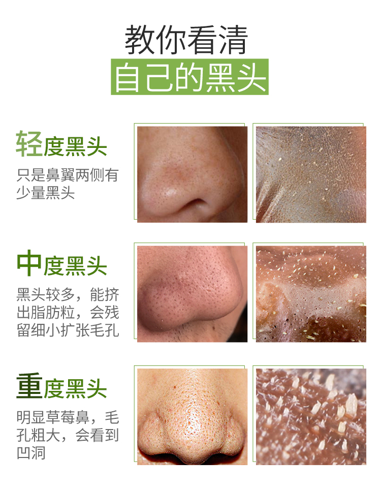 最新去黑头教程视频汇总，科技助力美丽重塑，黑头无忧新篇章